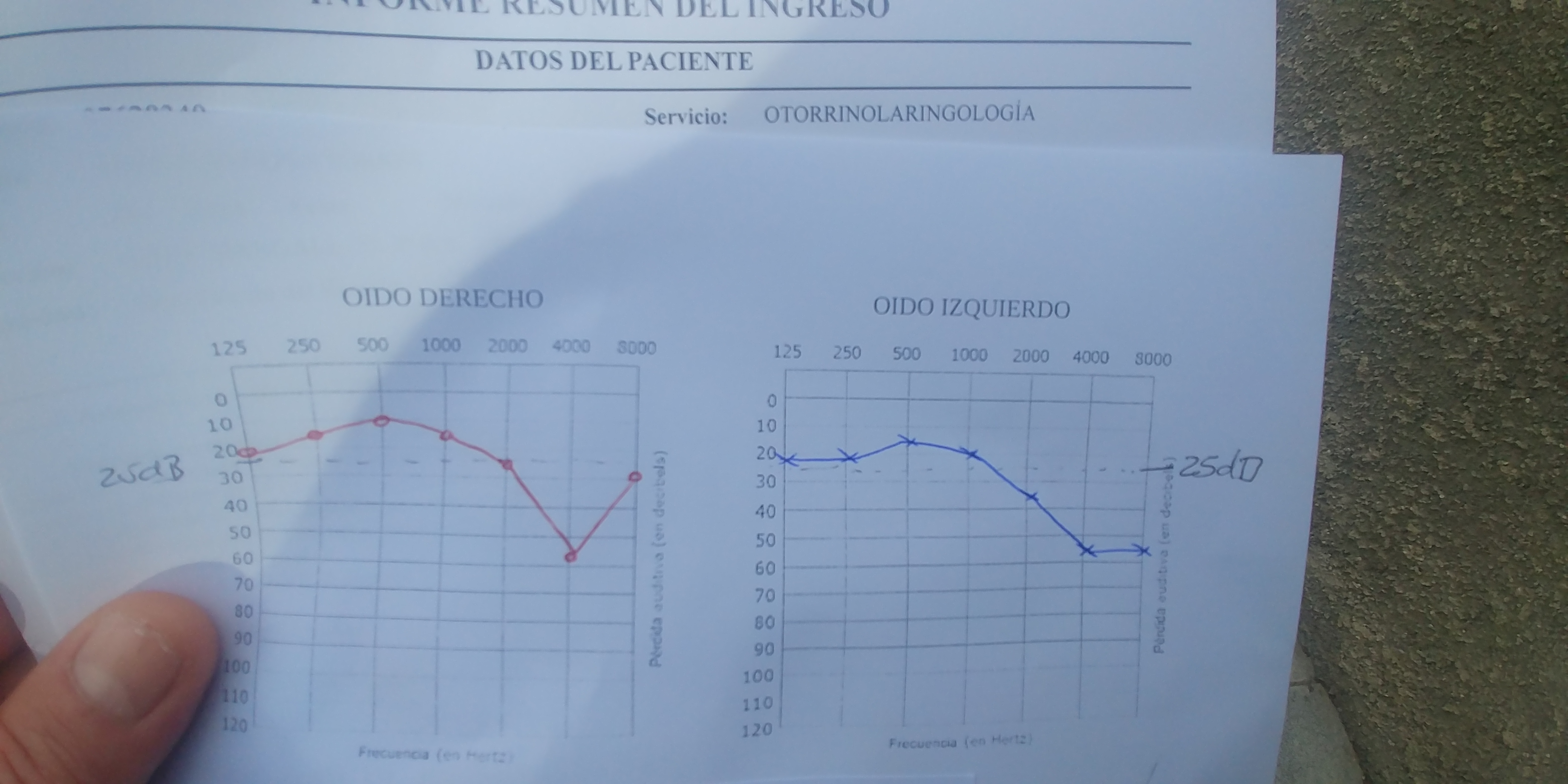 Acufenos, perdida auditiva y audifonos